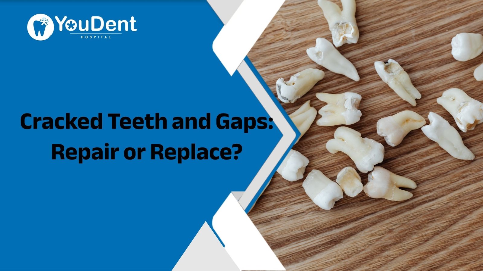 Cracked Teeth and Gaps